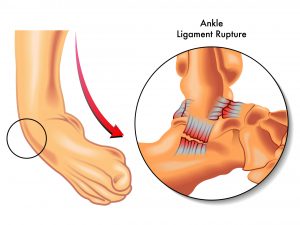 23117023 – ankle ligament rupture