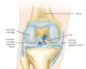 Anterior_Cruciate_Ligament_Injur-1-e1560361789649