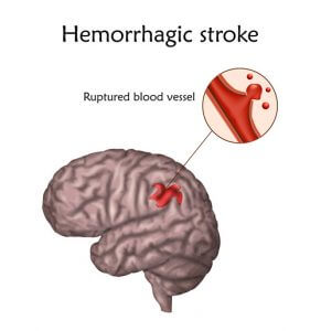 hemorrhagic