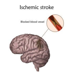 ischemic