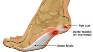 plantar-fascia
