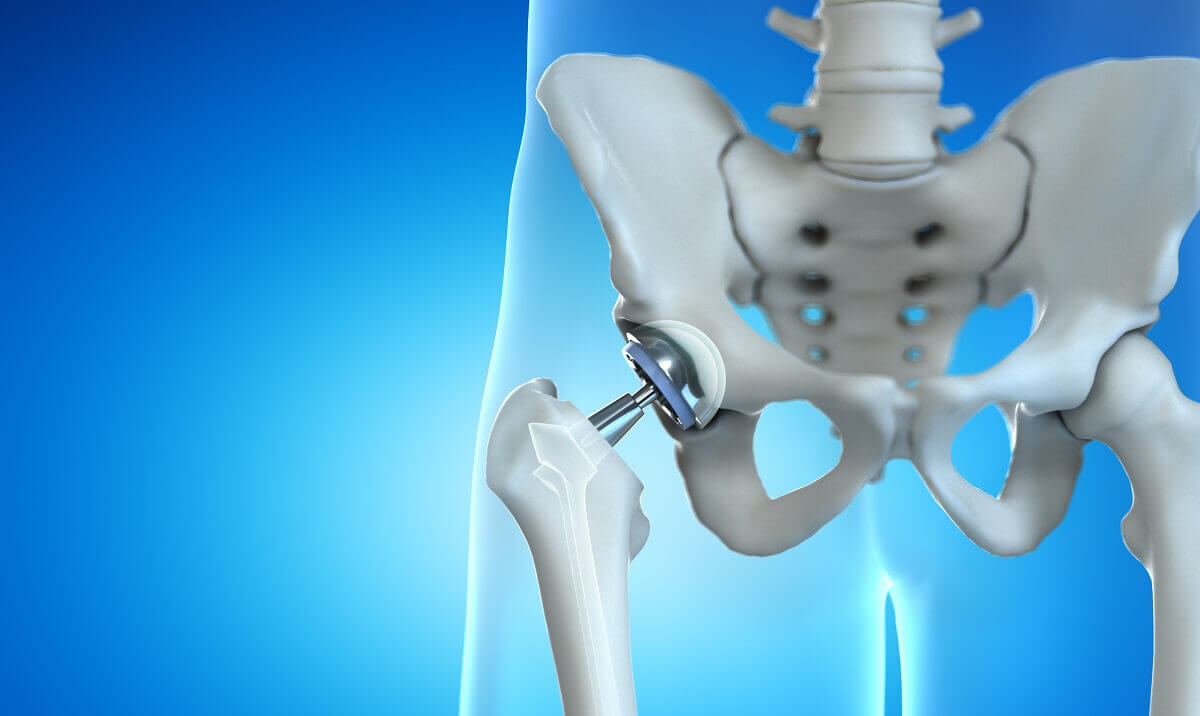 Cara Penjagaan Total Hip Replacement (THR) Atau Penggantian Pinggul