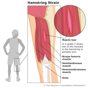 hamstringSprain-400×400-rd1-enIL